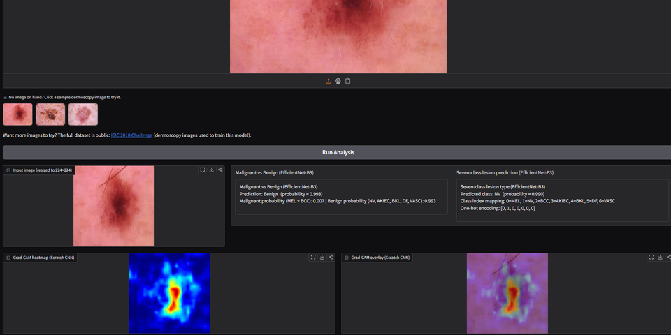 Skin cancer Detection and classification using computer vision
